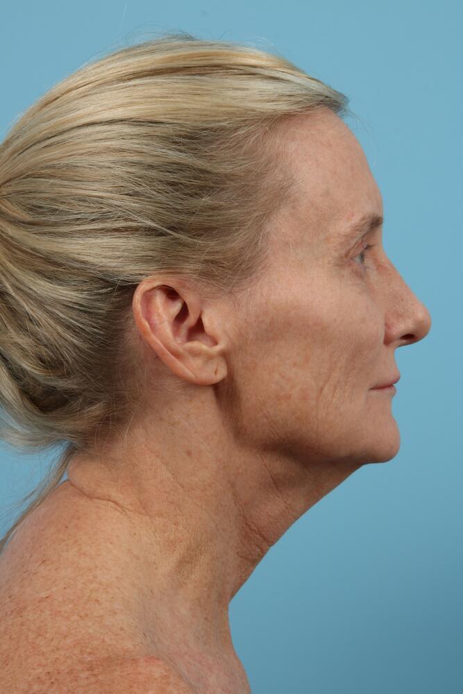 Facelifts Before & After Image