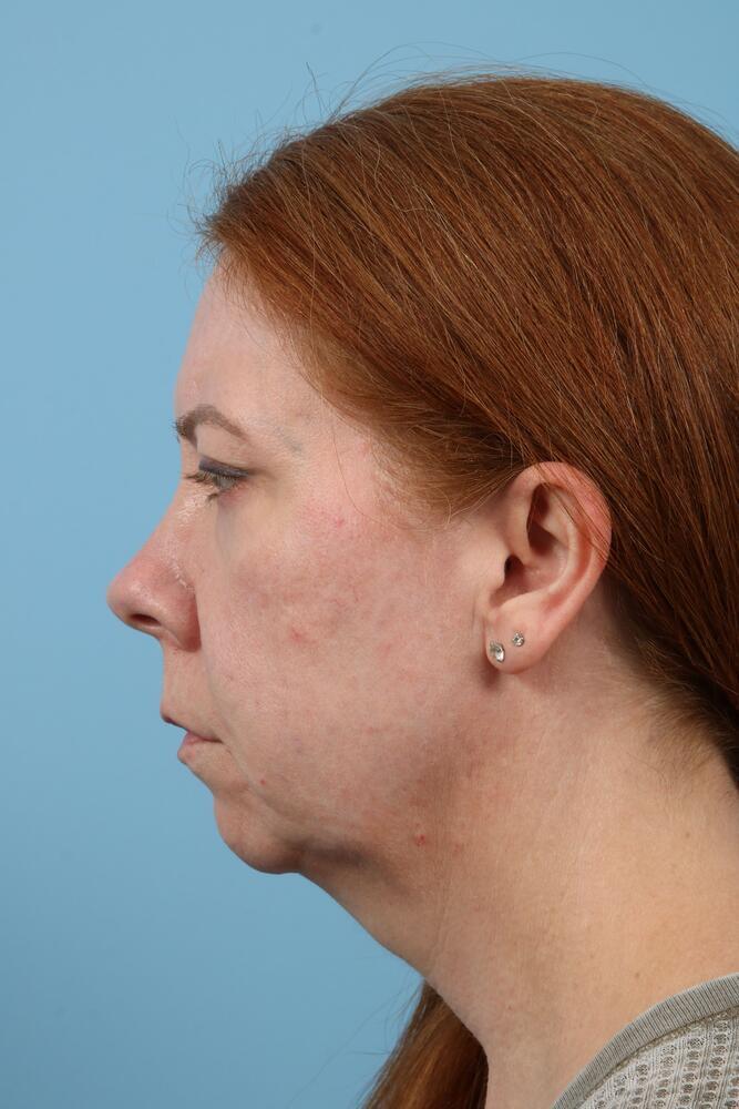 Facelifts Before & After Image