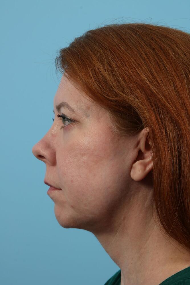 Facelifts Before & After Image