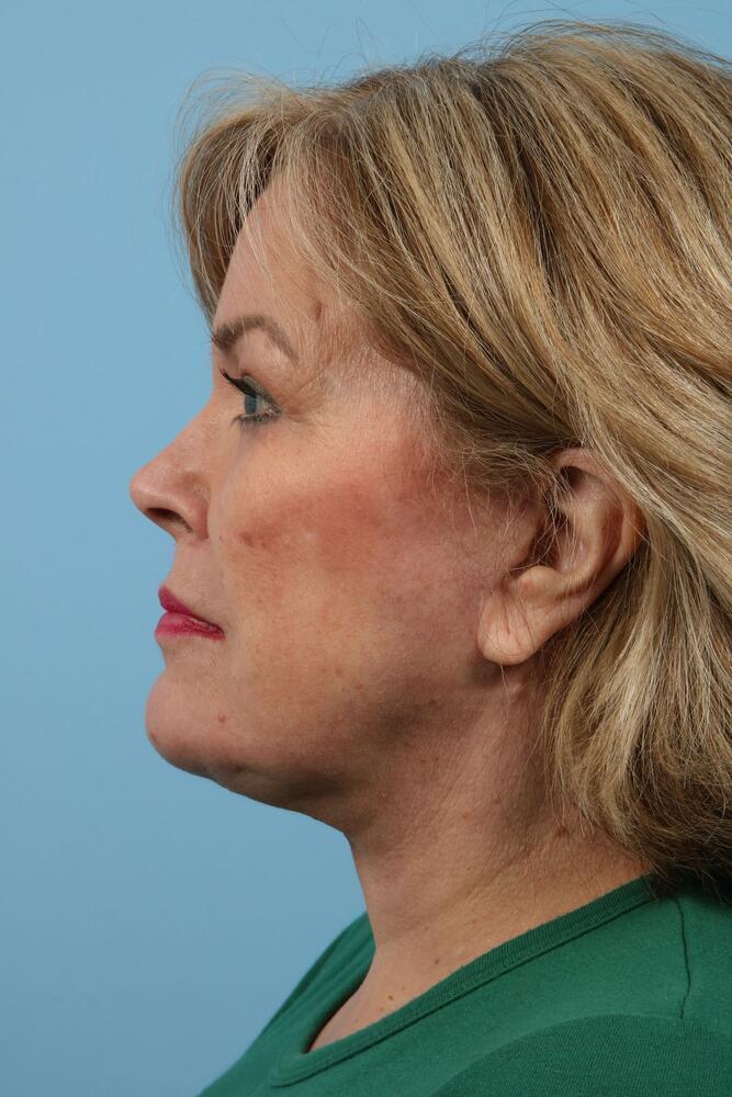 Facelifts Before & After Image