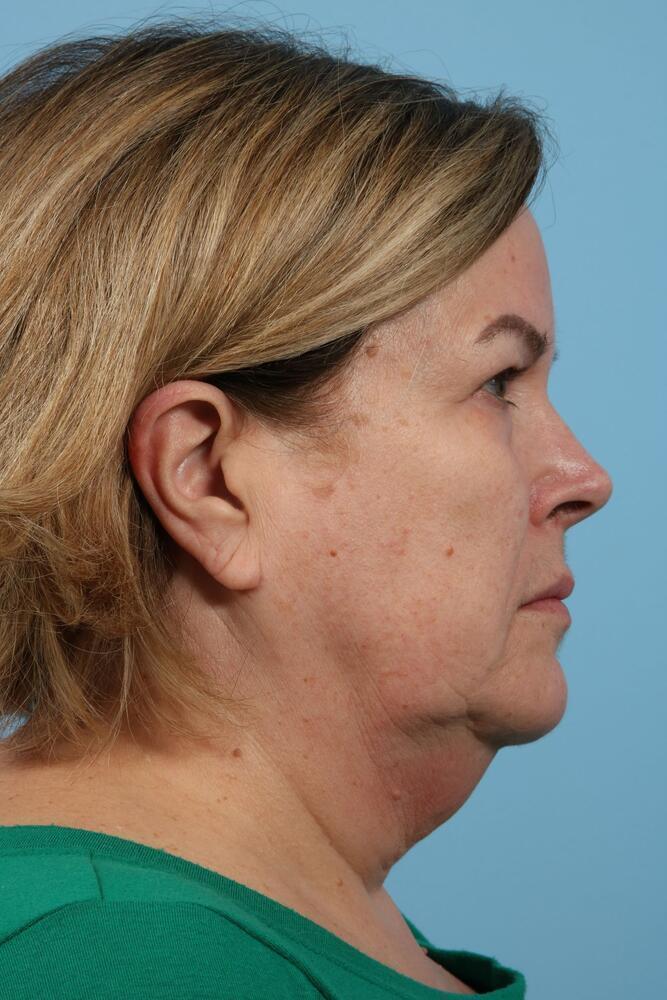 Facelifts Before & After Image