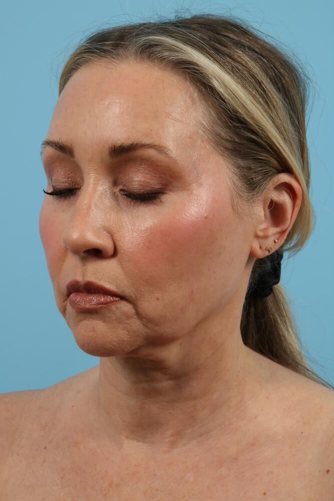 Facelifts Before & After Image