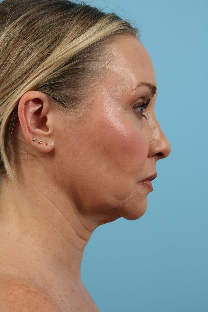 Facelifts Before & After Image