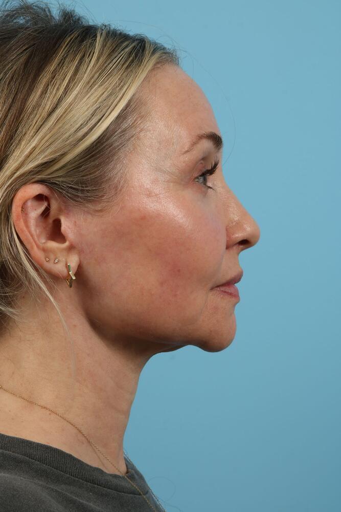 Facelifts Before & After Image