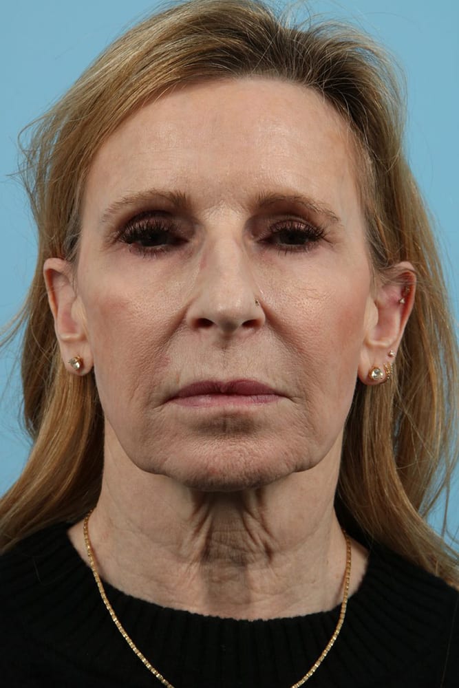 Facelifts Before & After Image