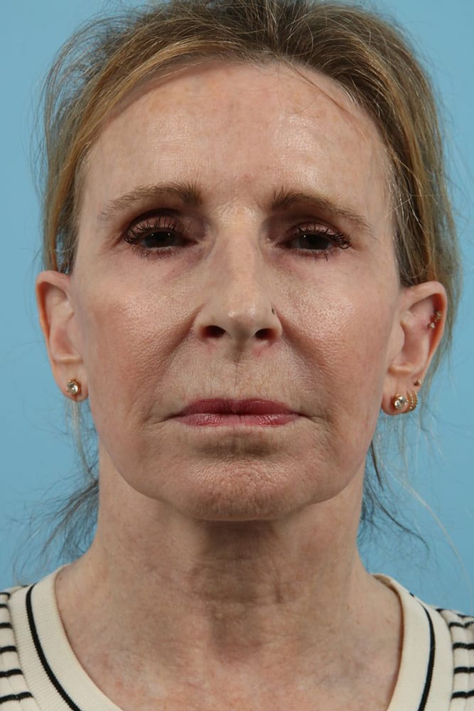 Facelifts Before & After Image