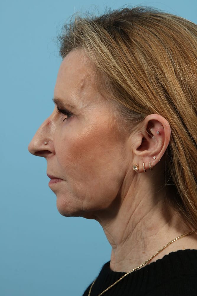 Facelifts Before & After Image