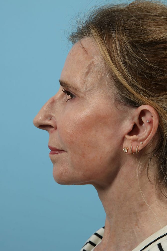 Facelifts Before & After Image