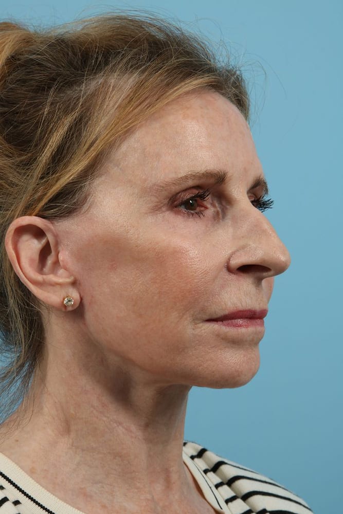 Facelifts Before & After Image