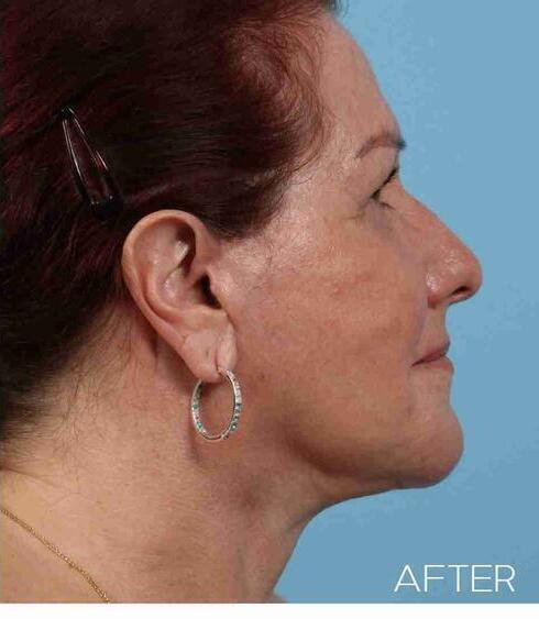 Neck Lift Before & After Image