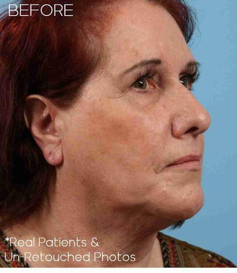 Neck Lift Before & After Image