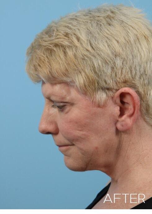 Neck Lift Before & After Image