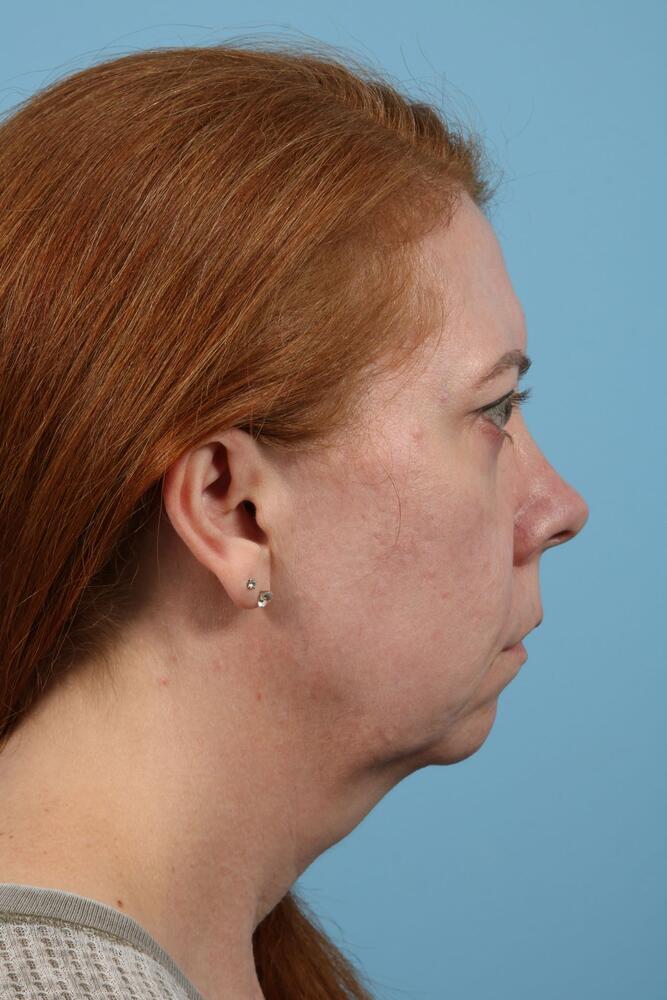 Neck Lift Before & After Image