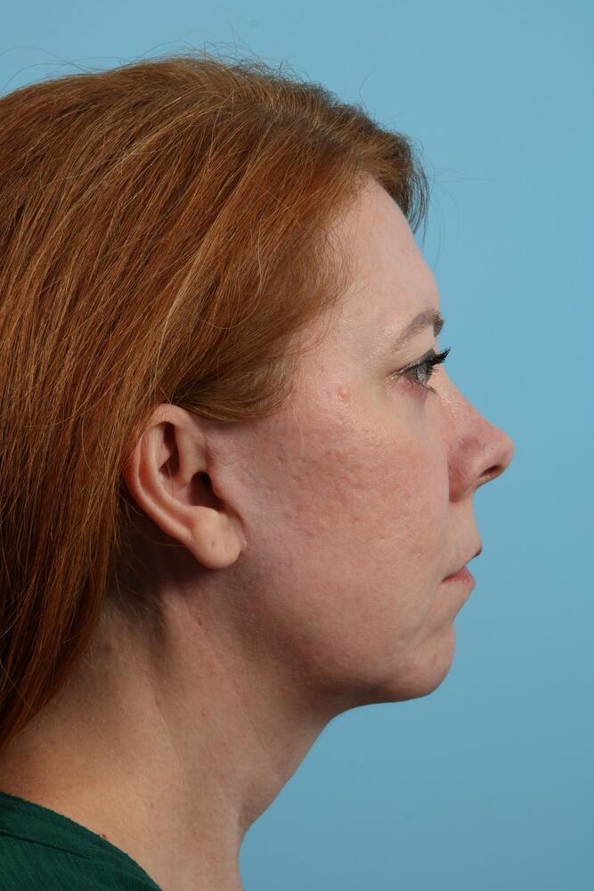 Neck Lift Before & After Image