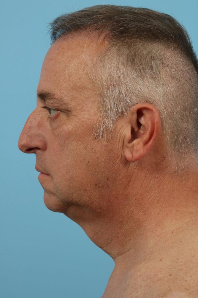 Neck Lift Before & After Image