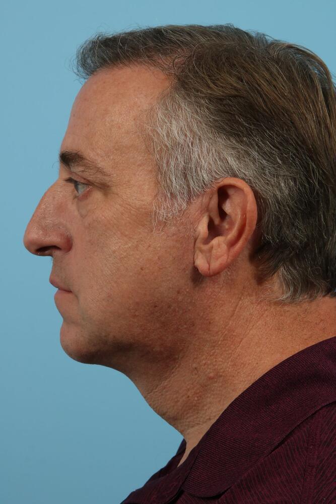 Neck Lift Before & After Image