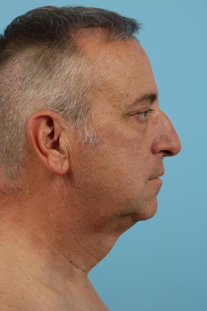 Neck Lift Before & After Image