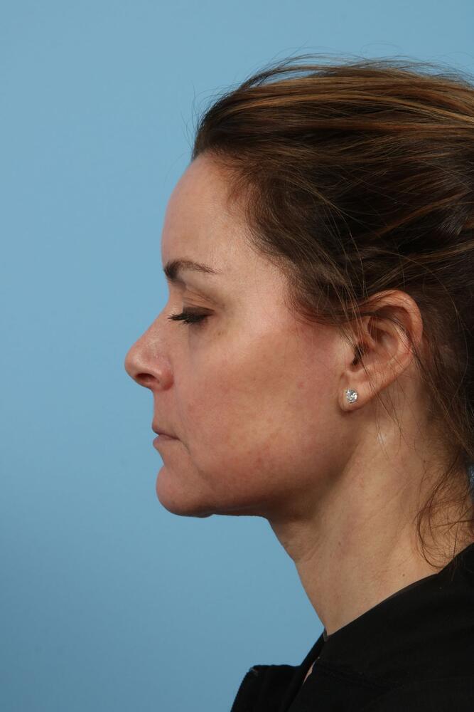 Neck Lift Before & After Image