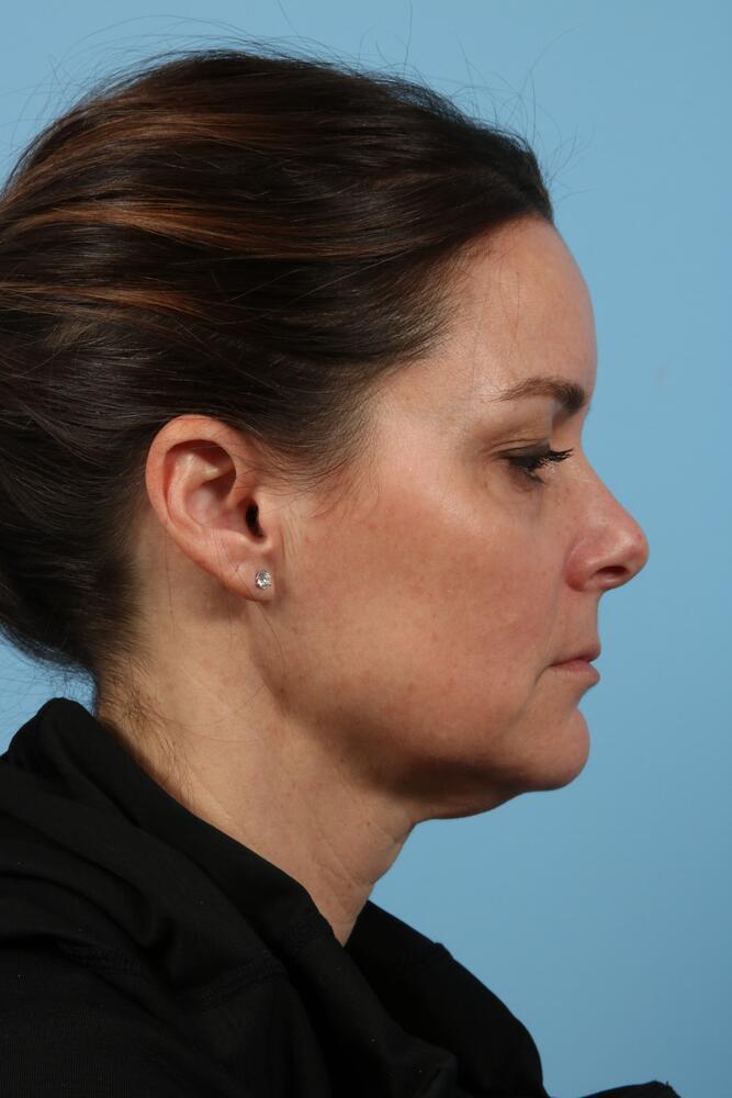 Neck Lift Before & After Image