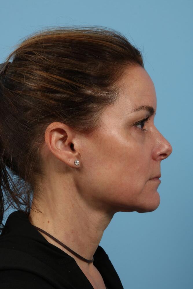 Neck Lift Before & After Image