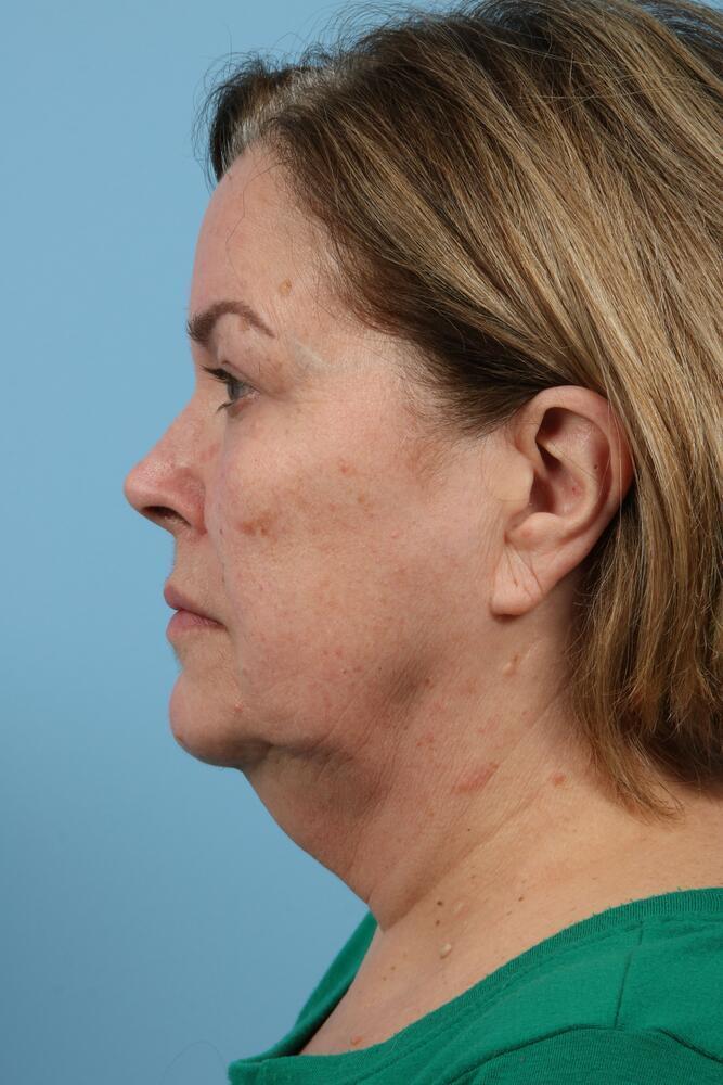 Neck Lift Before & After Image