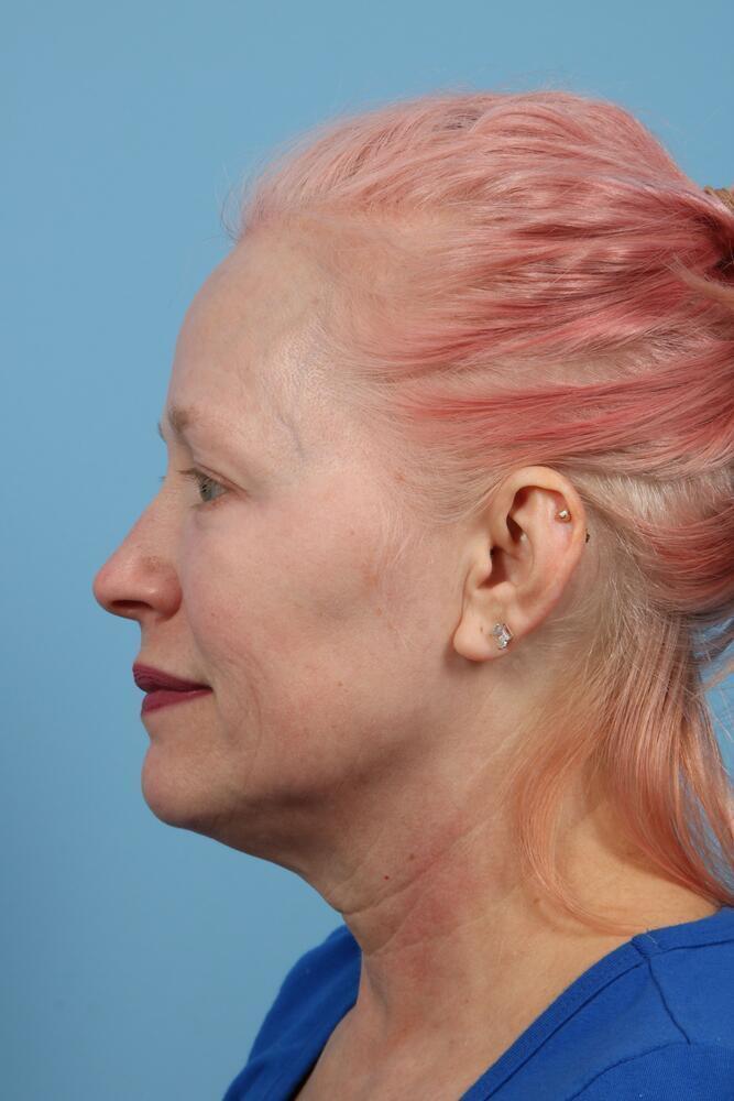 Neck Lift Before & After Image