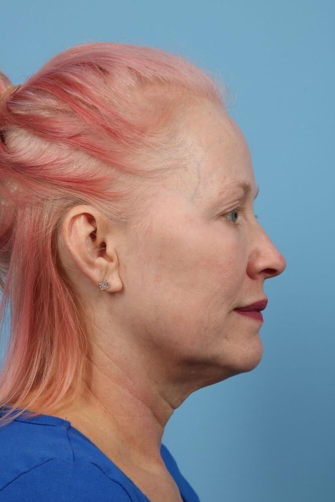 Neck Lift Before & After Image