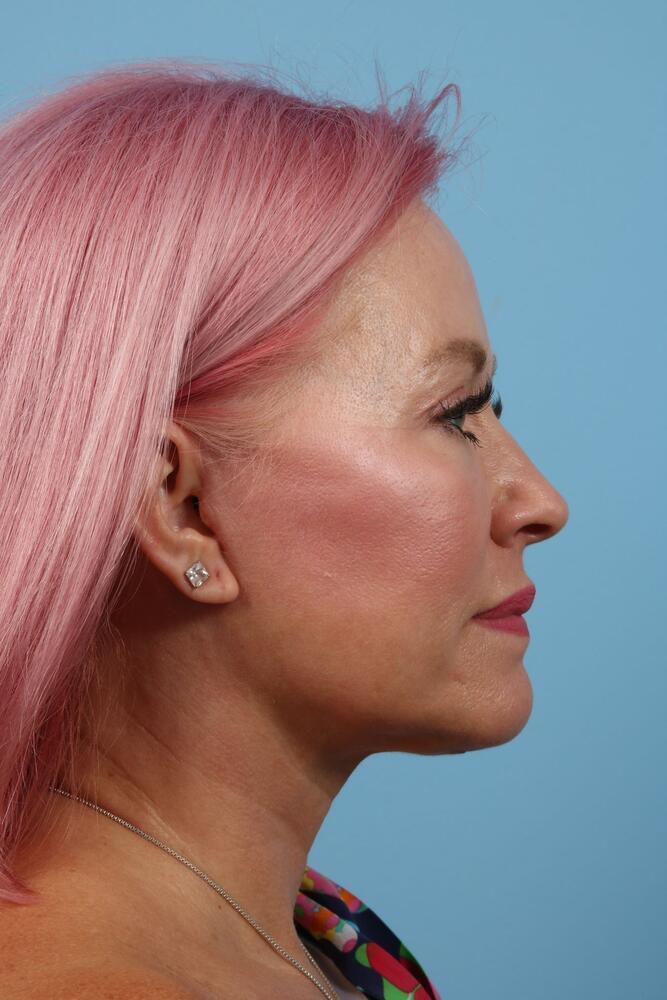 Neck Lift Before & After Image