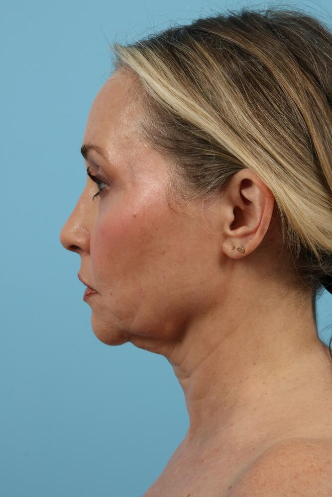 Neck Lift Before & After Image