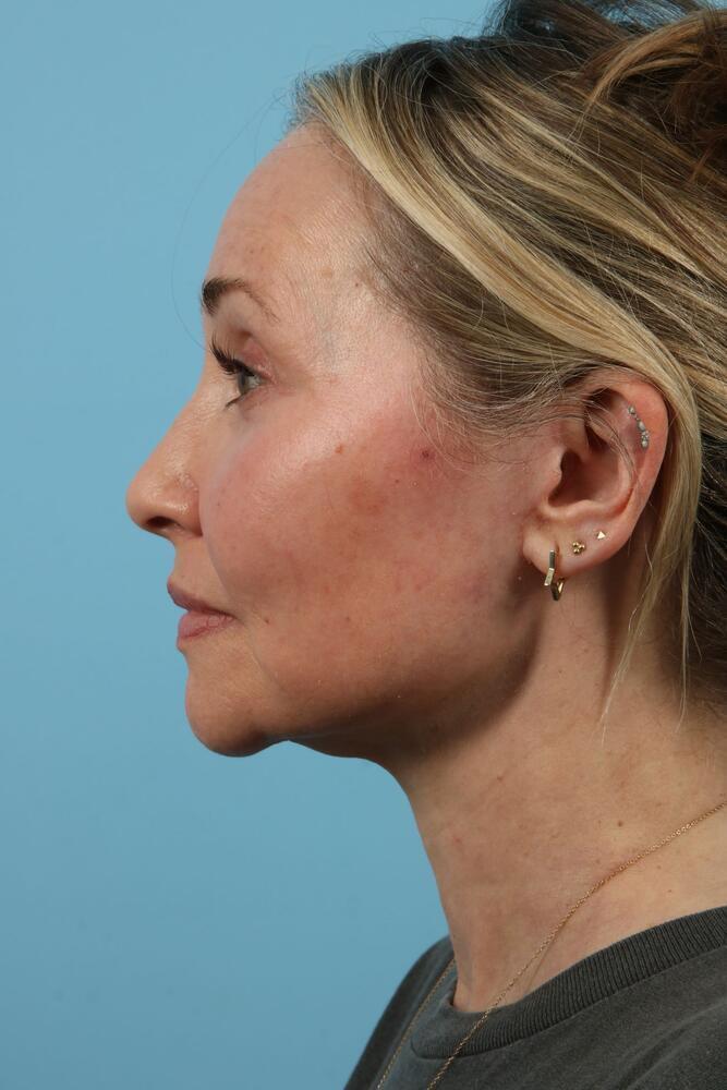 Neck Lift Before & After Image