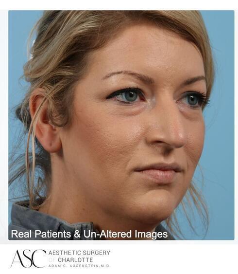 Rhinoplasty Before & After Image