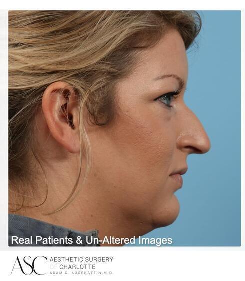 Rhinoplasty Before & After Image