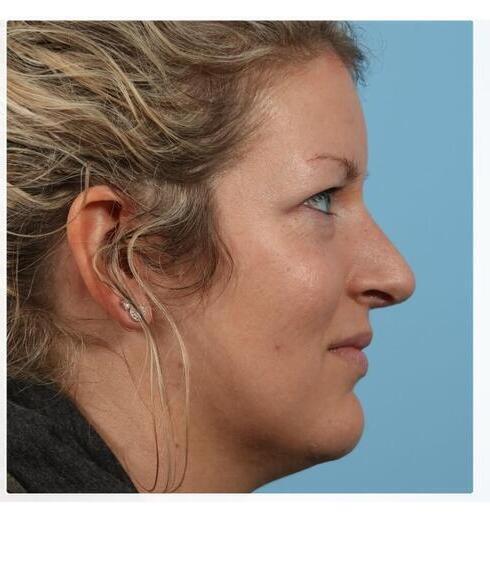 Rhinoplasty Before & After Image