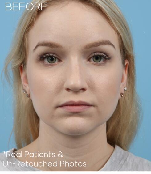 Rhinoplasty Before & After Image