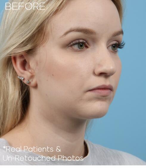 Rhinoplasty Before & After Image