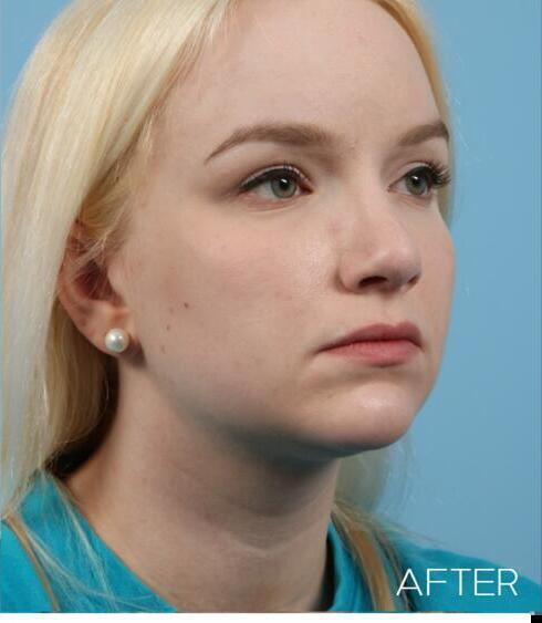 Rhinoplasty Before & After Image