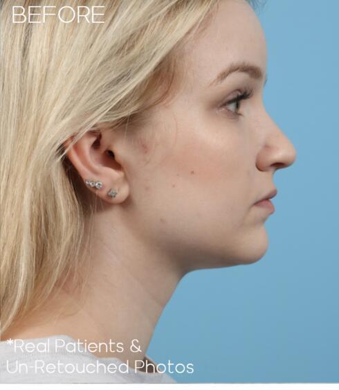 Rhinoplasty Before & After Image