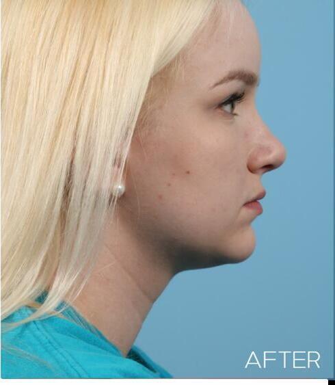 Rhinoplasty Before & After Image