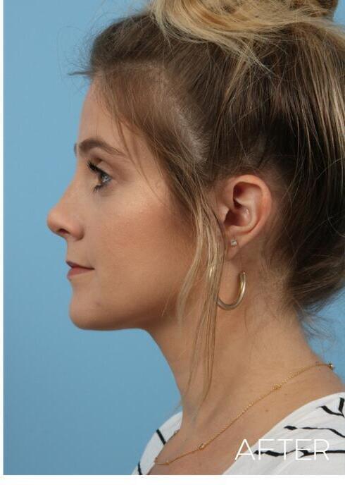 Rhinoplasty Before & After Image