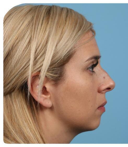 Rhinoplasty Before & After Image