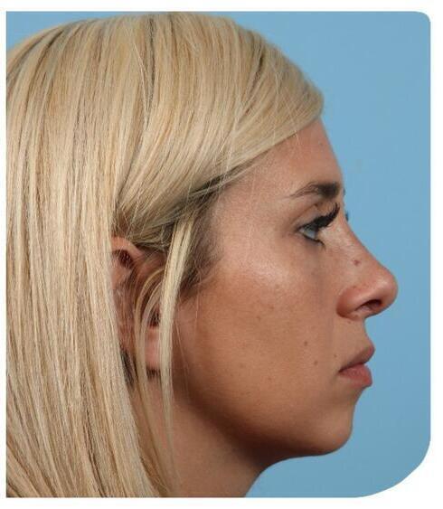 Rhinoplasty Before & After Image