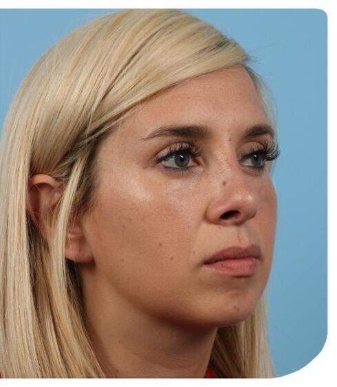 Rhinoplasty Before & After Image