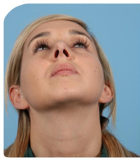 Rhinoplasty Before & After Image