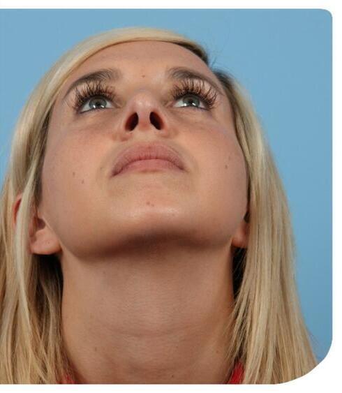 Rhinoplasty Before & After Image