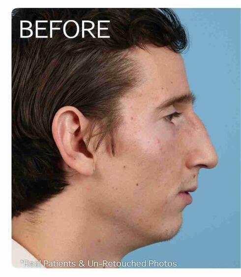 Rhinoplasty Before & After Image