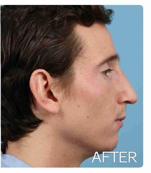 Rhinoplasty Before & After Image