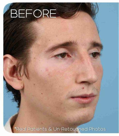 Rhinoplasty Before & After Image