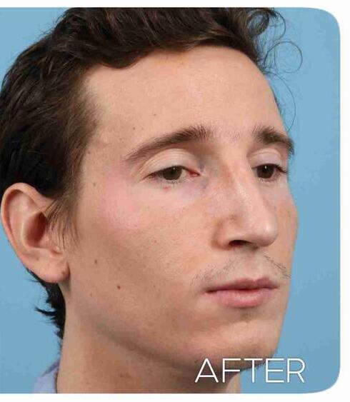 Rhinoplasty Before & After Image