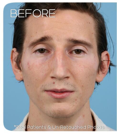 Rhinoplasty Before & After Image