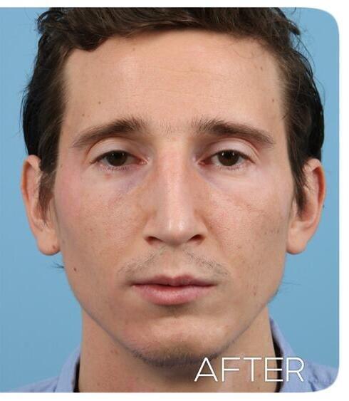 Rhinoplasty Before & After Image